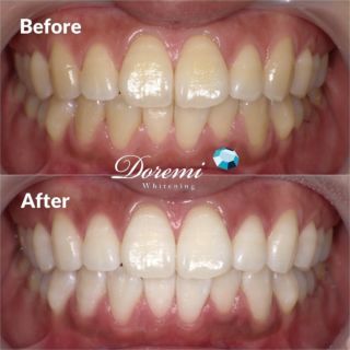 ホワイトニングのご相談は 岡山市の ドレミ インプラント ビューティー へ