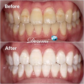 ホワイトニングのご相談は 岡山市の ドレミ インプラント ビューティー へ